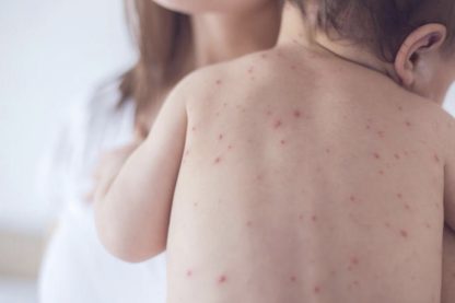 Measles ‘Covid’ measures could force unvaccinated children into three-week isolation